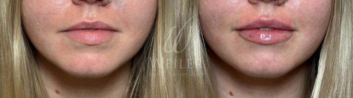 Before & After Lip Augmentation Case 1450 Front View in Baton Rouge, New Orleans, & Lafayette, Louisiana