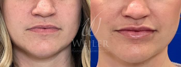 Before & After Restylane® Case 1451 Front View in Baton Rouge, New Orleans, & Lafayette, Louisiana