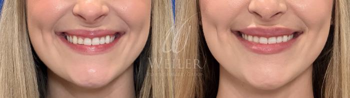 Before & After Lip Augmentation Case 1452 Front View in Baton Rouge, New Orleans, & Lafayette, Louisiana