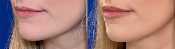 Before & After Lip Augmentation Case 1452 Left Side View in Baton Rouge, New Orleans, & Lafayette, Louisiana