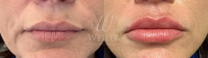 Before & After Lip Augmentation Case 1470 Front View in Baton Rouge, New Orleans, & Lafayette, Louisiana