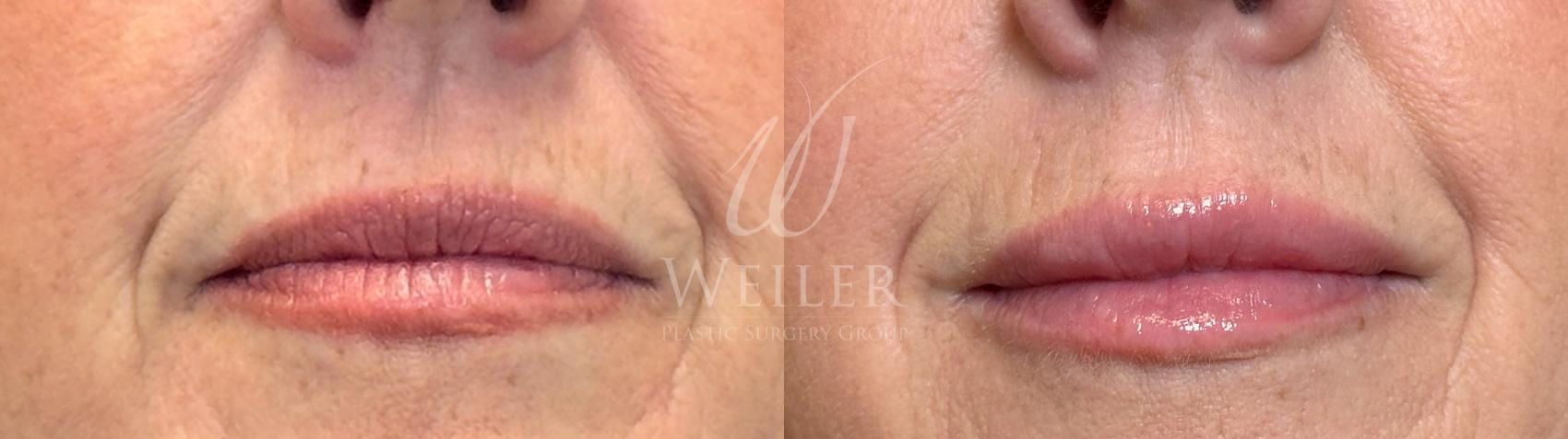 Before & After Lip Augmentation Case 1471 Front View in Baton Rouge, New Orleans, & Lafayette, Louisiana
