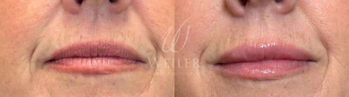 Before & After Lip Augmentation Case 1471 Front View in Baton Rouge, New Orleans, & Lafayette, Louisiana