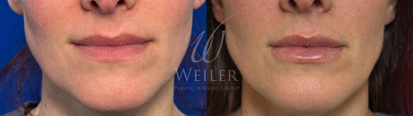 Before & After Lip Augmentation Case 1475 Front View in Baton Rouge, New Orleans, & Lafayette, Louisiana