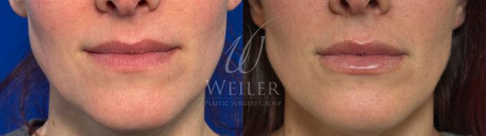Before & After Lip Augmentation Case 1475 Front View in Baton Rouge, New Orleans, & Lafayette, Louisiana