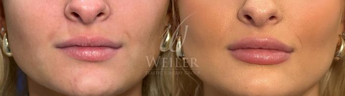 Before & After Lip Augmentation Case 1479 Front View in Baton Rouge, New Orleans, & Lafayette, Louisiana