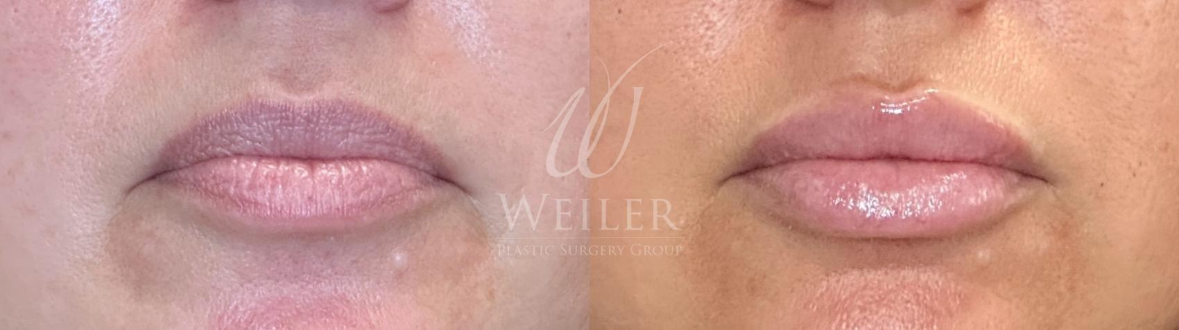Before & After Lip Augmentation Case 1487 Front View in Baton Rouge, New Orleans, & Lafayette, Louisiana