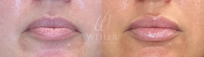 Before & After Lip Augmentation Case 1487 Front View in Baton Rouge, New Orleans, & Lafayette, Louisiana