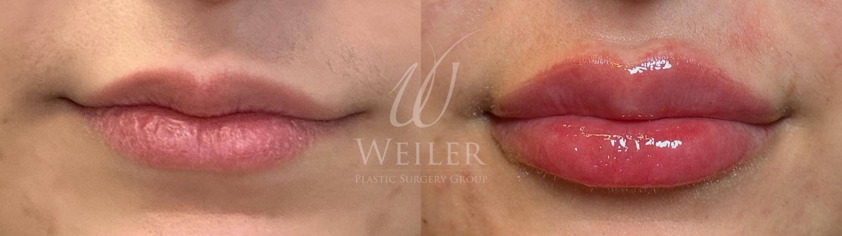 Before & After Lip Augmentation Case 1489 Front View in Baton Rouge, New Orleans, & Lafayette, Louisiana