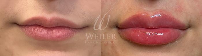 Before & After Lip Augmentation Case 1489 Front View in Baton Rouge, New Orleans, & Lafayette, Louisiana