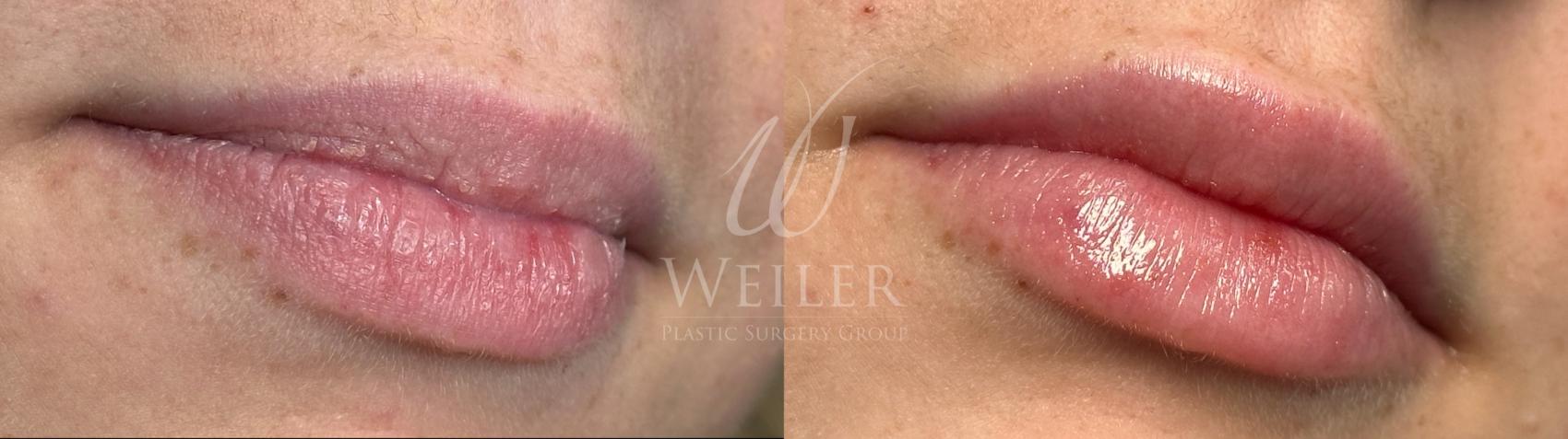 Before & After Lip Augmentation Case 1490 Front View in Baton Rouge, New Orleans, & Lafayette, Louisiana