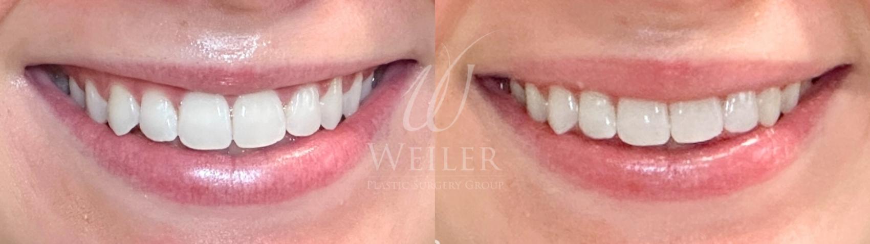 Before & After Lip Augmentation Case 1495 Front View in Baton Rouge, New Orleans, & Lafayette, Louisiana