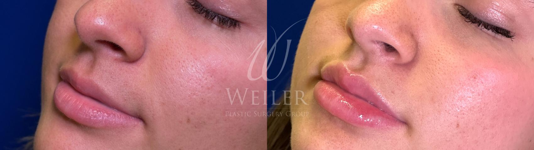 Before & After Lip Augmentation Case 1496 Left Oblique View in Baton Rouge, New Orleans, & Lafayette, Louisiana