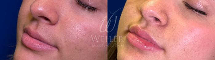 Before & After Lip Augmentation Case 1496 Left Oblique View in Baton Rouge, New Orleans, & Lafayette, Louisiana