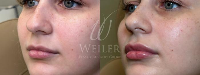Before & After Lip Augmentation Case 1503 Left Oblique View in Baton Rouge, New Orleans, & Lafayette, Louisiana