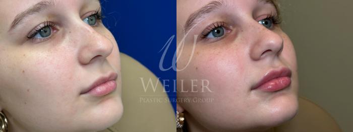 Before & After Lip Augmentation Case 1503 Right Oblique View in Baton Rouge, New Orleans, & Lafayette, Louisiana