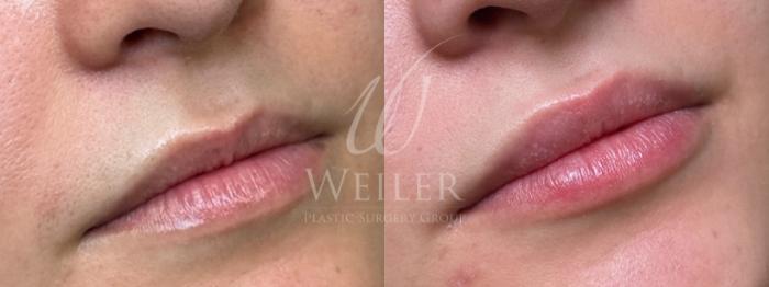 Before & After Lip Augmentation Case 1521 Right Oblique View in Baton Rouge, New Orleans, & Lafayette, Louisiana