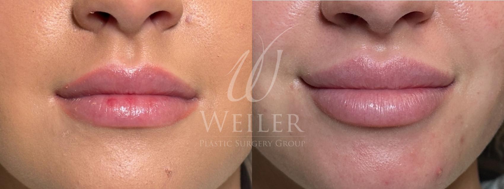 Before & After Lip Augmentation Case 1522 Front View in Baton Rouge, New Orleans, & Lafayette, Louisiana