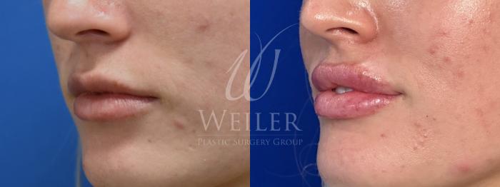 Before & After Lip Augmentation Case 1523 Left Oblique View in Baton Rouge, New Orleans, & Lafayette, Louisiana
