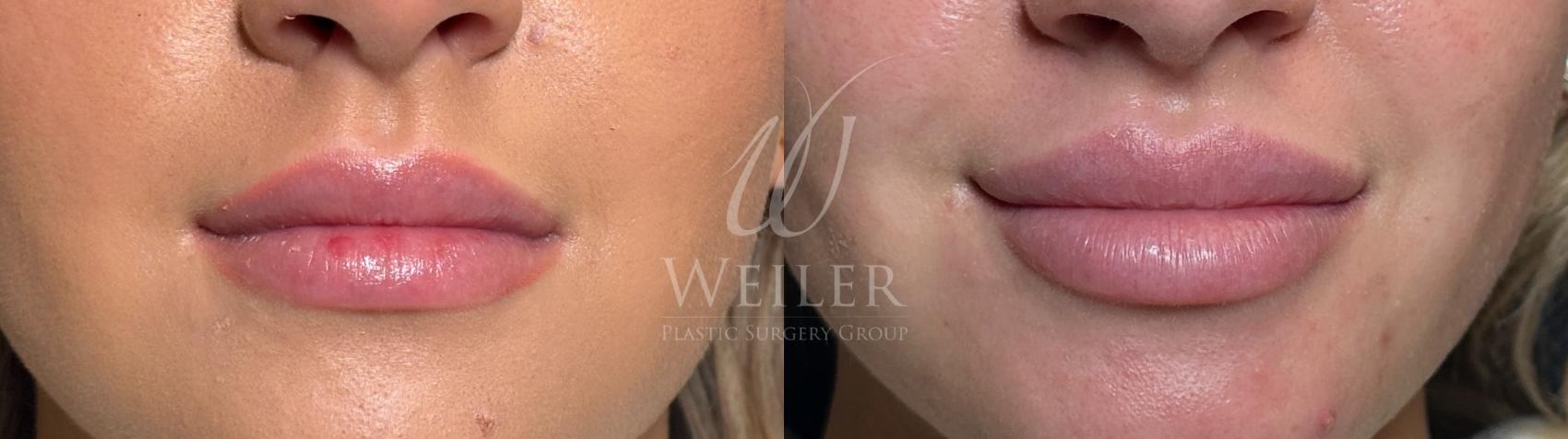 Before & After Lip Augmentation Case 1532 Front View in Baton Rouge, New Orleans, & Lafayette, Louisiana