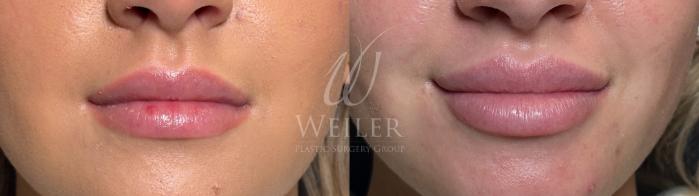 Before & After Lip Augmentation Case 1532 Front View in Baton Rouge, New Orleans, & Lafayette, Louisiana