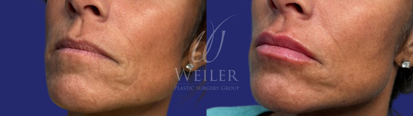 Before & After Lip Augmentation Case 1539 Right Oblique View in Baton Rouge, New Orleans, & Lafayette, Louisiana