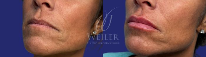 Before & After Lip Augmentation Case 1539 Right Oblique View in Baton Rouge, New Orleans, & Lafayette, Louisiana