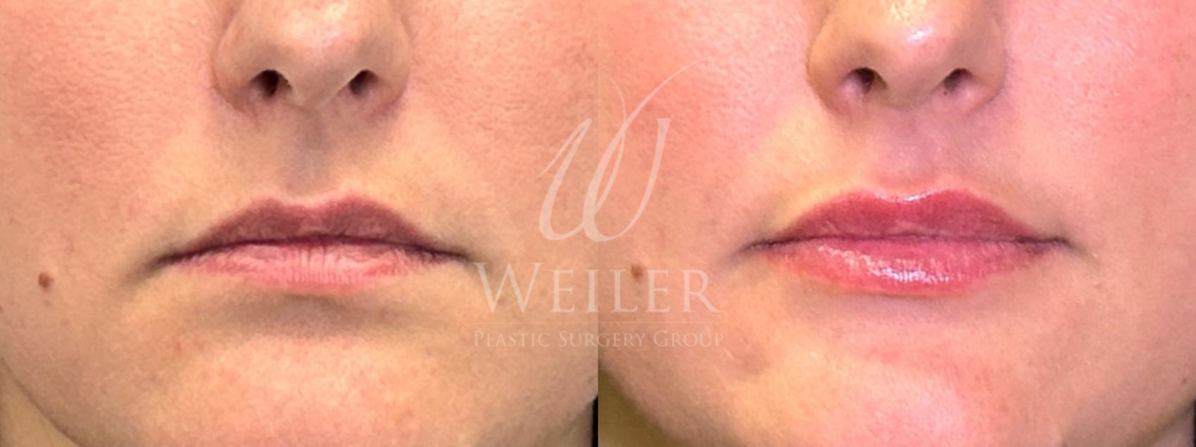 Before & After Lip Augmentation Case 1541 Front View in Baton Rouge, New Orleans, & Lafayette, Louisiana