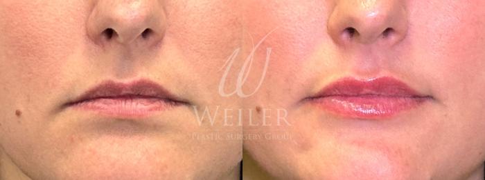 Before & After Lip Augmentation Case 1541 Front View in Baton Rouge, New Orleans, & Lafayette, Louisiana