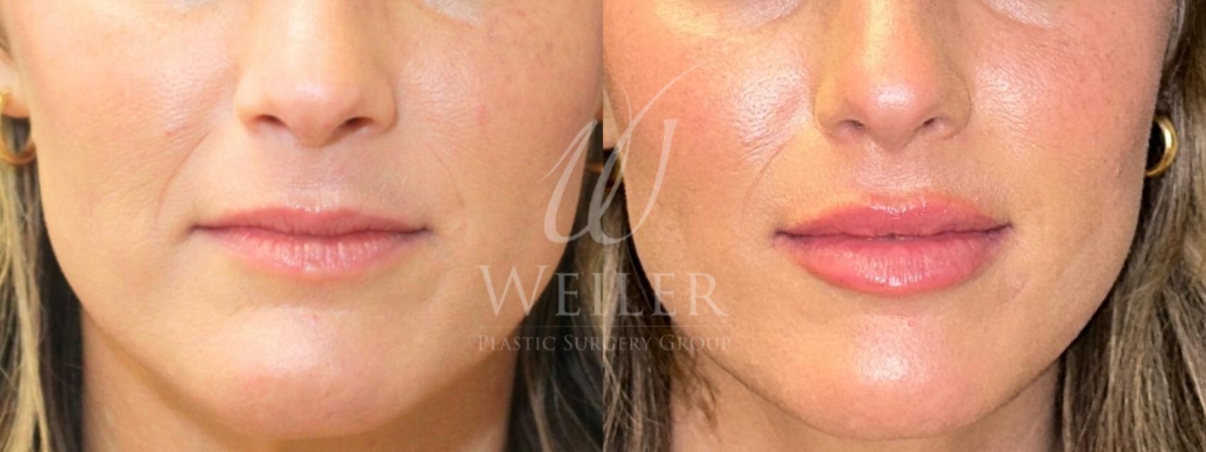 Before & After Lip Augmentation Case 1542 Front View in Baton Rouge, New Orleans, & Lafayette, Louisiana
