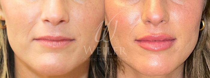 Before & After Lip Augmentation Case 1542 Front View in Baton Rouge, New Orleans, & Lafayette, Louisiana