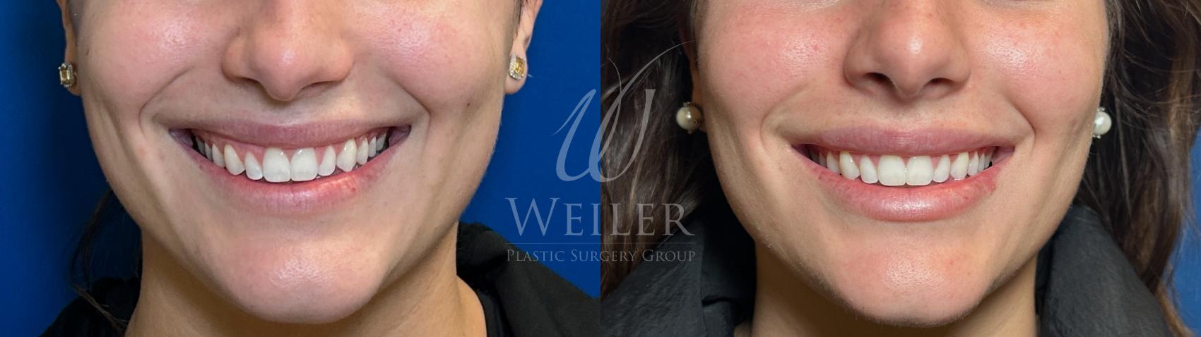 Before & After Lip Augmentation Case 1554 Front View in Baton Rouge, New Orleans, & Lafayette, Louisiana