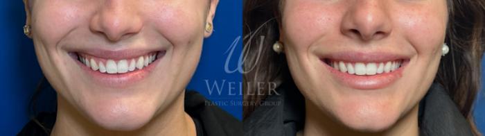 Before & After Lip Augmentation Case 1554 Front View in Baton Rouge, New Orleans, & Lafayette, Louisiana