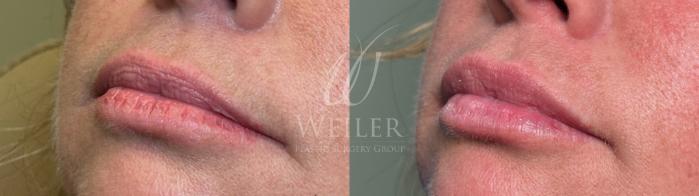 Before & After Lip Augmentation Case 1556 Left Oblique View in Baton Rouge, New Orleans, & Lafayette, Louisiana
