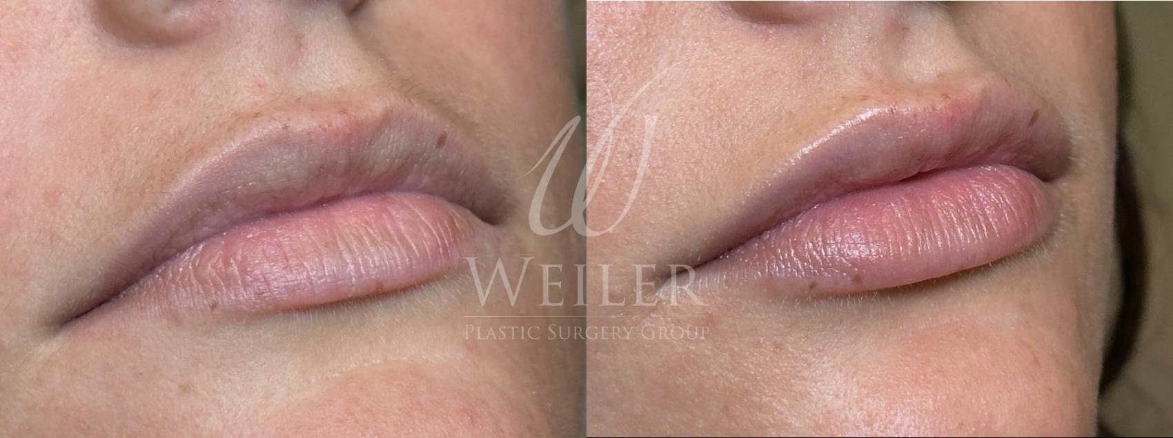 Before & After JUVÉDERM® Case 1562 Right Oblique View in Baton Rouge, New Orleans, & Lafayette, Louisiana