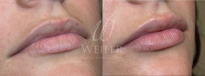Before & After JUVÉDERM® Case 1562 Right Oblique View in Baton Rouge, New Orleans, & Lafayette, Louisiana