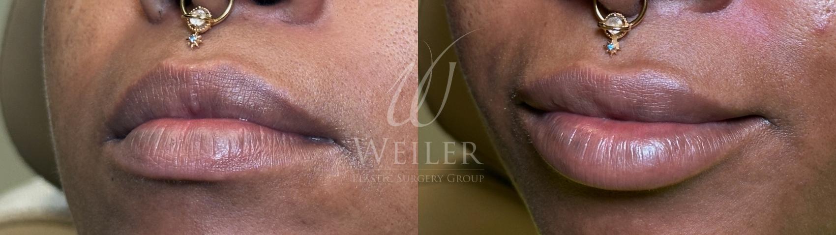 Before & After Lip Augmentation Case 1563 Left Oblique View in Baton Rouge, New Orleans, & Lafayette, Louisiana