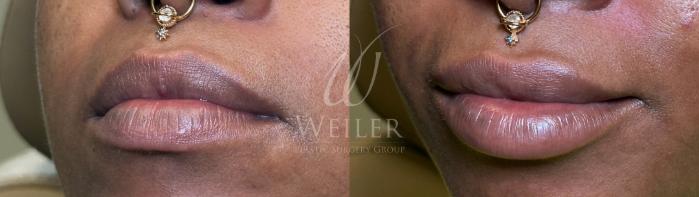 Before & After Lip Augmentation Case 1563 Left Oblique View in Baton Rouge, New Orleans, & Lafayette, Louisiana