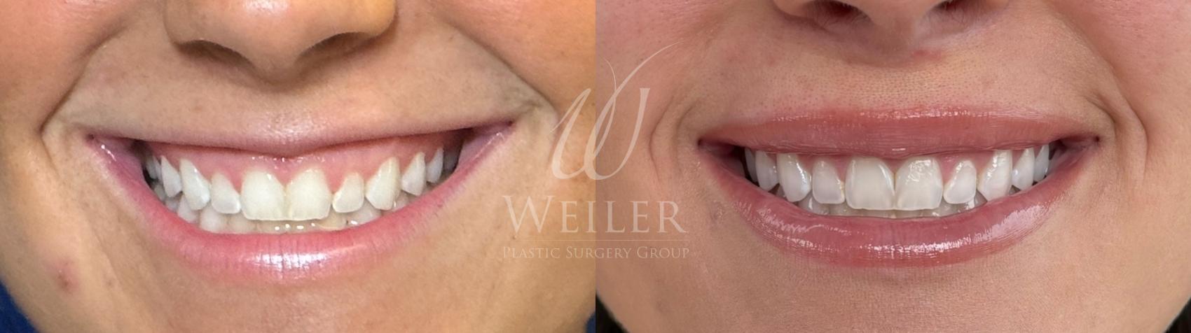 Before & After Lip Augmentation Case 1564 Front View in Baton Rouge, New Orleans, & Lafayette, Louisiana