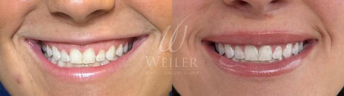 Before & After Lip Augmentation Case 1564 Front View in Baton Rouge, New Orleans, & Lafayette, Louisiana