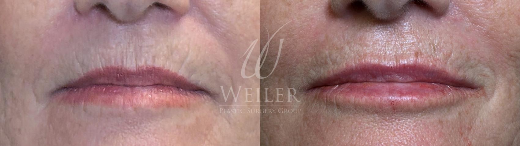 Before & After Lip Augmentation Case 1566 Front View in Baton Rouge, New Orleans, & Lafayette, Louisiana