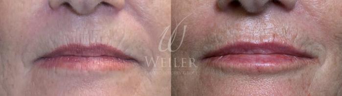 Before & After Lip Augmentation Case 1566 Front View in Baton Rouge, New Orleans, & Lafayette, Louisiana