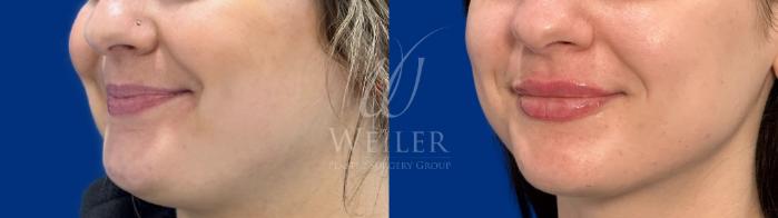 Before & After JUVÉDERM® Case 1568 Left Oblique View in Baton Rouge, New Orleans, & Lafayette, Louisiana