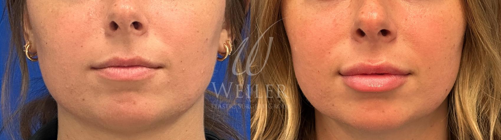 Before & After Lip Augmentation Case 1569 Front View in Baton Rouge, New Orleans, & Lafayette, Louisiana