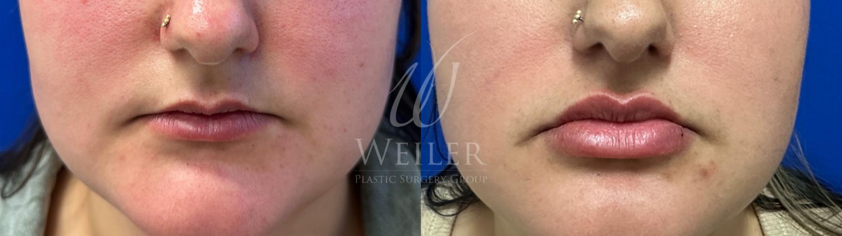 Before & After Lip Augmentation Case 1574 Front View in Baton Rouge, New Orleans, & Lafayette, Louisiana