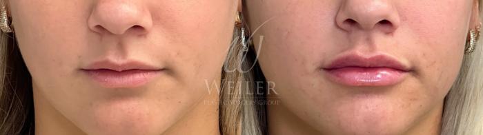 Before & After Lip Augmentation Case 1581 Front View in Baton Rouge, New Orleans, & Lafayette, Louisiana