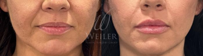 Before & After Lip Augmentation Case 1582 Front View in Baton Rouge, New Orleans, & Lafayette, Louisiana
