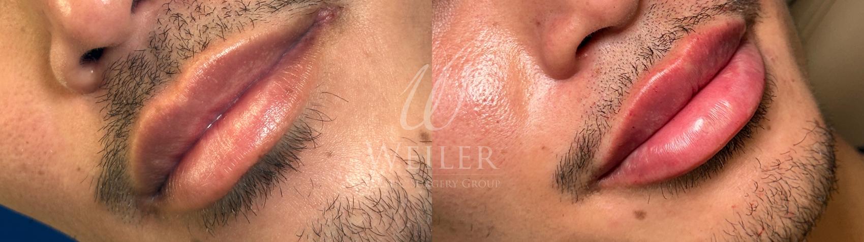 Before & After Restylane® Case 1609 Front View in Baton Rouge, New Orleans, & Lafayette, Louisiana