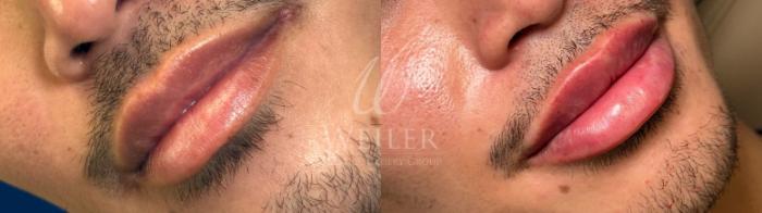 Before & After Restylane® Case 1609 Front View in Baton Rouge, New Orleans, & Lafayette, Louisiana