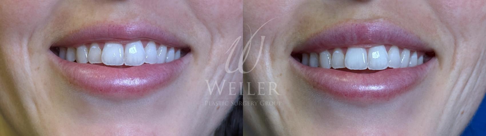 Before & After Lip Augmentation Case 1611 Front View in Baton Rouge, New Orleans, & Lafayette, Louisiana